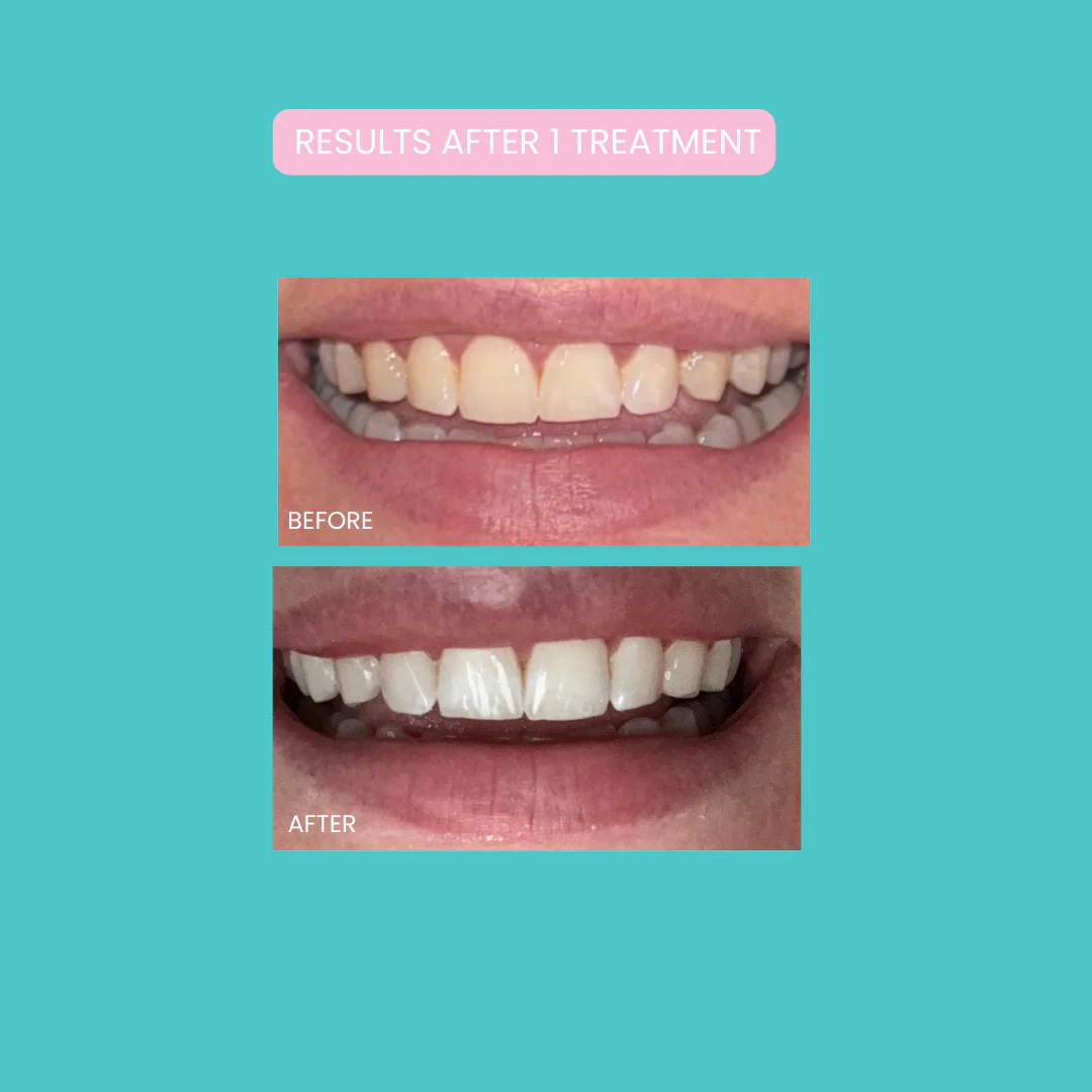 Smilie Boost Teeth Whitening Kit - Developed By Dentists - Image 6