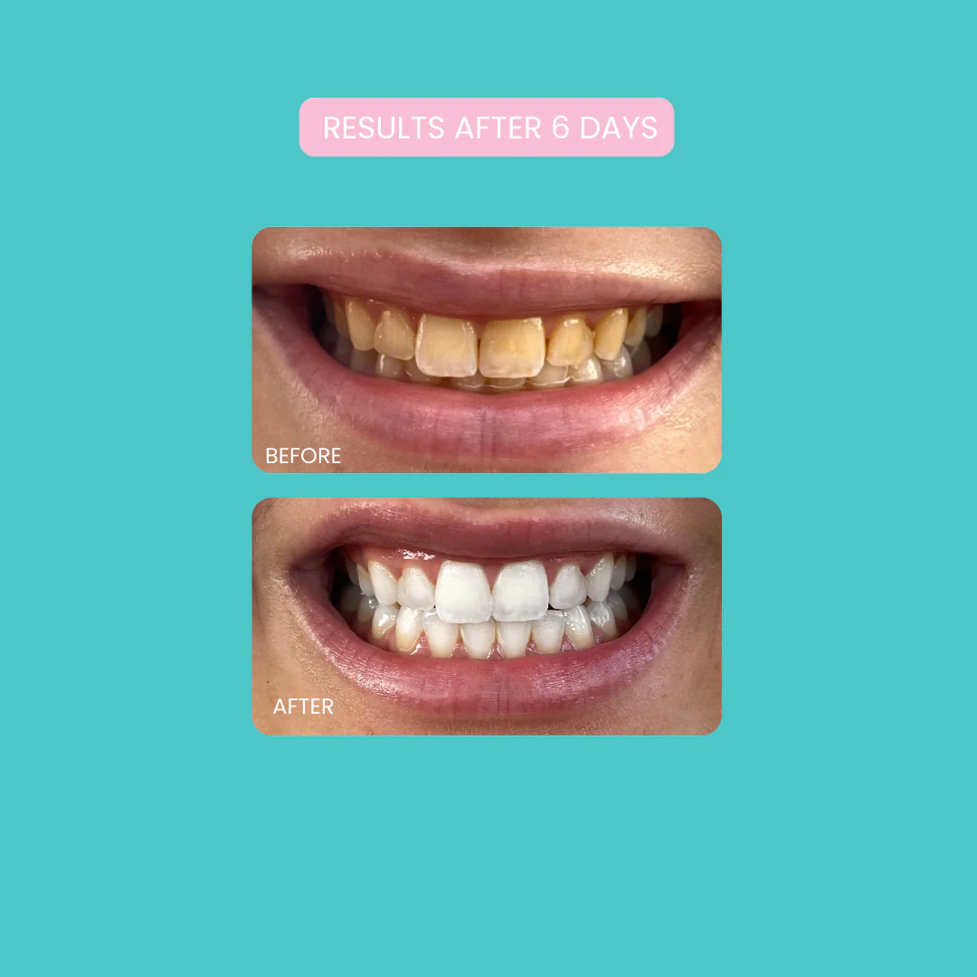 Smilie Boost Teeth Whitening Kit - Developed By Dentists - Image 8