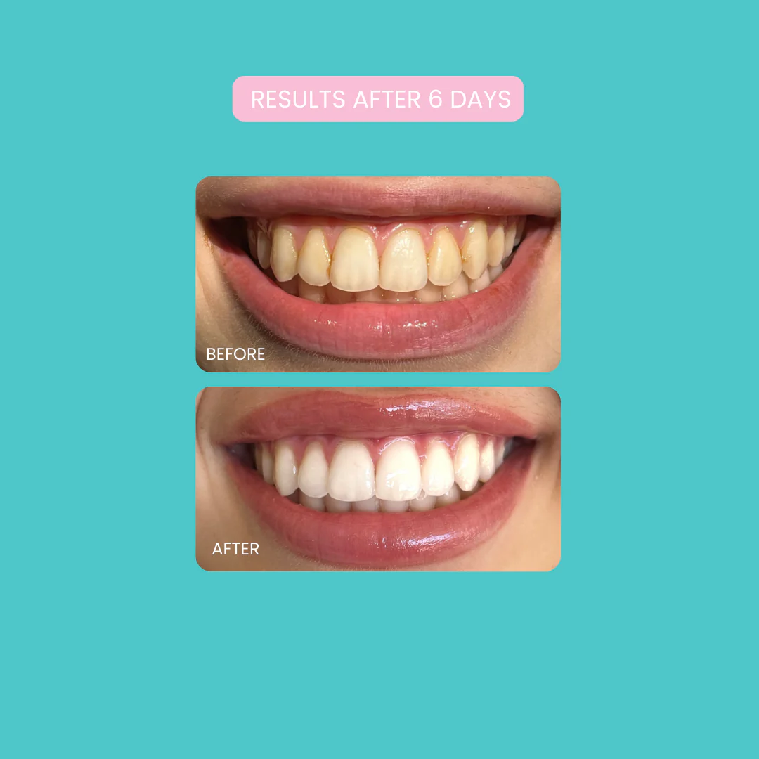Smilie Boost Teeth Whitening Kit - Developed By Dentists - Image 9